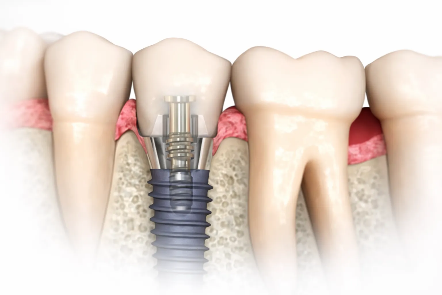 Implantologia a Milazzo