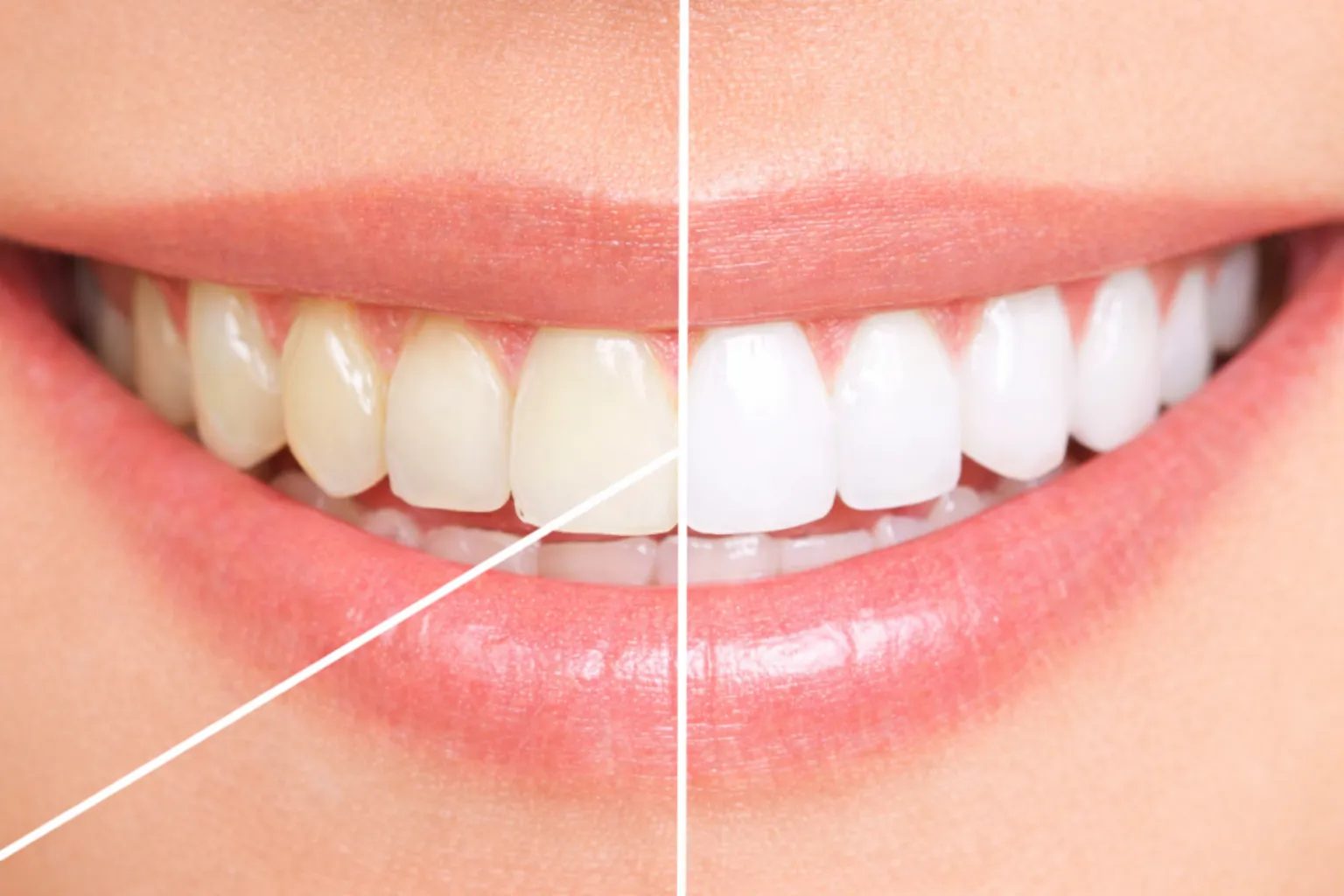 Igiene orale e sbiancamento dentale a Milazzo